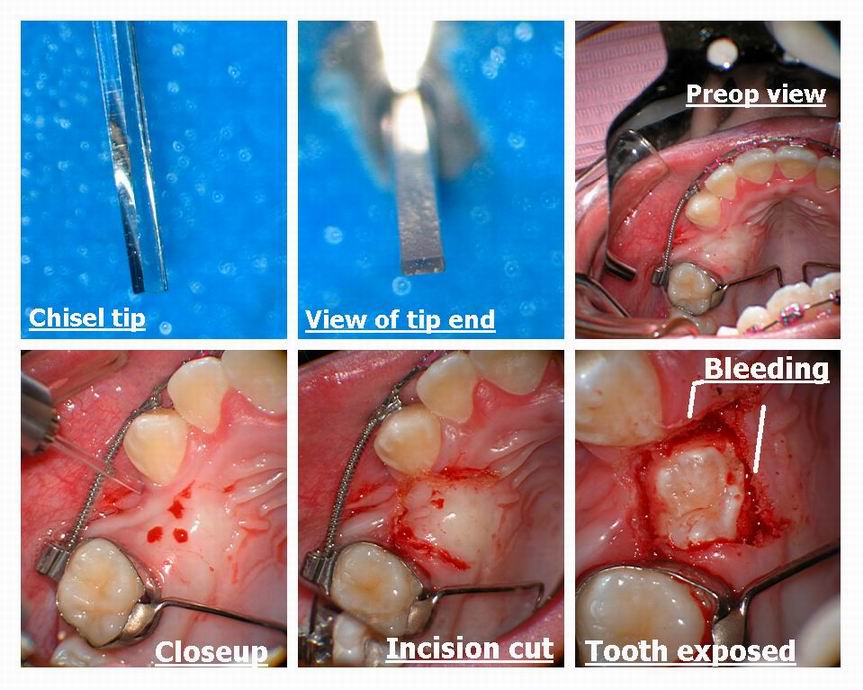 Resize of Exposure of premolar pg 1.jpg